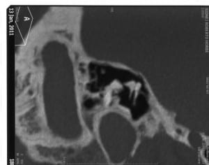 3b)Temporal Bone CT: Underdeveloped right mastoid mastoid