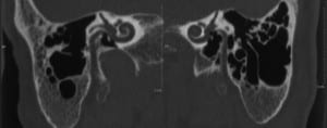 3a) Temporal Bone CT: underdeveloped mastoides.