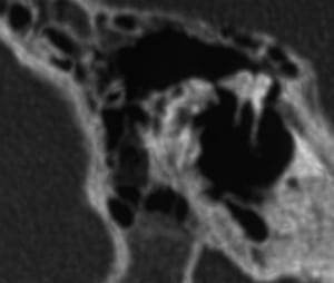 Middle ear ossicles, Malleus and Incus, as seen in computorized tomography of teh temporal bone at tha sagital plane, right ear.