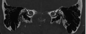 Tomografia Mastoide Normal, Normal Mastoid Tomography